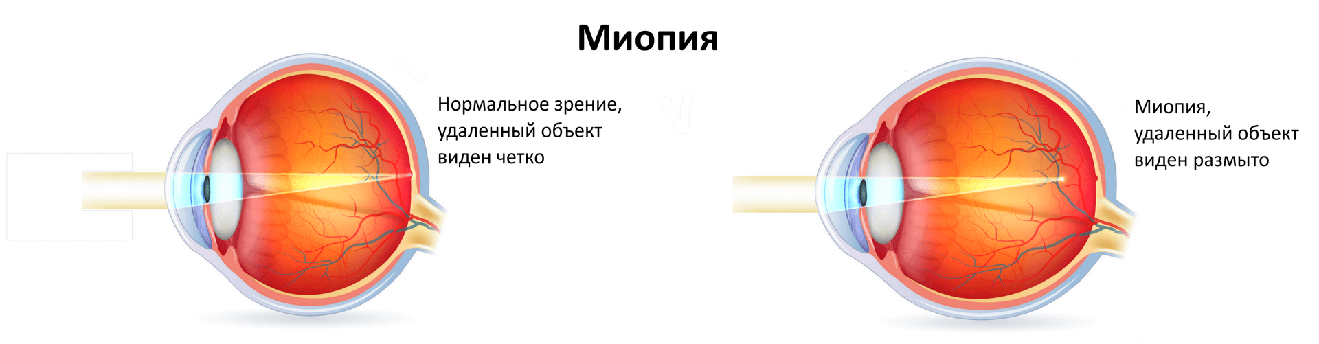 Миопия что это простыми словами. Миопия. Миопия глаза что это такое. Близорукость офтальмология. Зрение при близорукости.